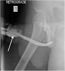 Image result for Retrograde Urethrogram