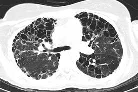 Image result for XRay Changes in Rheumatic Conditions