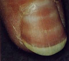 Image result for Muehrcke Line