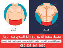عمليات نحت الجسم للرجال شفط الدهون إزالة التثدي نحت الجسم الفريق الطبي يرحب بالاجابه على جميع استفساراتكم Whatsapp V Surgery Cosmetic Surgery Clinic