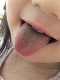 Image result for black hairy tongue symptoms