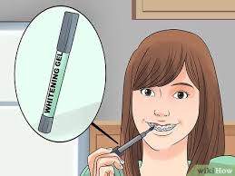 We recommend the auraglow teeth whitening kit and a great whitening toothpaste to remove stains as well as stainless steel straws, which can you can read more details in this business insider article that summarizes the study. 3 Ways To Whiten Your Teeth When You Have Braces Wikihow