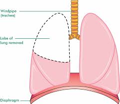Within days of starting treatment, she began to improve. Surgery For Lung Cancer Macmillan Cancer Support