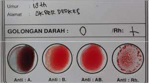 Check spelling or type a new query. Pemilik Golongan Darah O Lebih Berisiko Saat Alami Kecelakaan Tribun Jogja