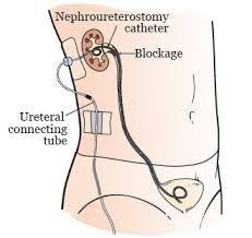 Pin On Double J Stent