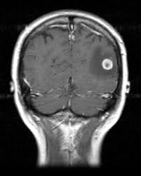 Signs and symptoms of metastasis. Brain Metastases Radiology Reference Article Radiopaedia Org