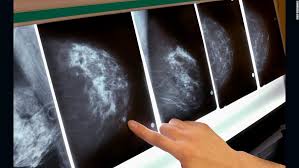 This equates to an overall 0.5% chance of being diagnosed with cancer after undergoing a screening mammogram. Third Of Breast Cancer Patients Treated Unnecessarily Study Says Cnn