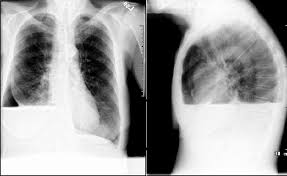 Image result for Pneumothorax