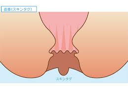 スキンタグ 手術 ブログ