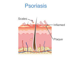 Image result for psoriasis