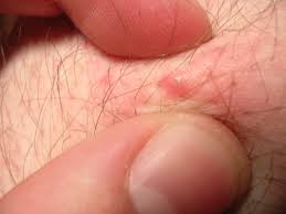 Most ingrown hairs will resolve without treatment. How To Get Rid Of Ingrown Hair Bumps Under Armpits