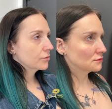 TRANSFORM YOUR LOOK 😻🥰😍 Before-and-after results with our signature  Facial Balancing Treatment with @trubeauty_rninjectorvictoria ⭐  @trubeauty_rninjectorvictoria 💉 @trubeauty_rninjectorvictoria 🙏🏻  @trubeauty_rninjectorvictoria 🙌🏼 $100 OFF NOW ...