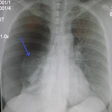 A couple examples are pneumothorax and hemothorax. Pneumothorax Wikipedia