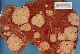 Most pancreatic cancers are exocrine cancers. Pancreatic Cancer Wikipedia