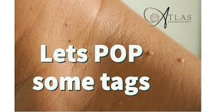 Image result for Skin Tag