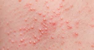 Die mallorca akne ist keine fälschlicherweise im internet oftmals als „geschlechtskrankheit entpuppte krankheit. Skincare Hilfe Ich Habe Eine Sonnenallergie Polymorphe Lichtdermatose Konsumkaiser