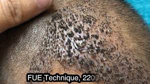 How Scalp Look After 10th Day Of Hair Transplant Hair Therapy Hair Transplant Best Hair Transplant