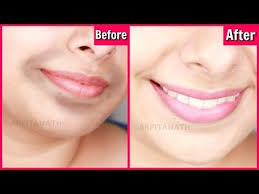 Remove Dark Black Patches Around Mouth In 15 Minutes Get Rid Of Hyper Pigmentation Youtube Dark Skin Around Mouth Dark Patches On Skin Dark Skin