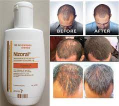 Nizoral is often one of the first solutions people suffering from hair loss look towards, but does it work? Ketoconazole Shampoo A Miraculous Anti Dandruff And Hair Loss Remedy