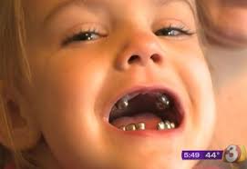 4 Year Old Girl Has All Her Teeth Capped With Silver Crowns Ends Up Looking Like James Bond Villain Teeth Caps Silver Crown 4 Year Old Girl