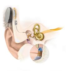 Ismail and mazlan rashid and r. Med El Cochlear Implants For Hearing Loss