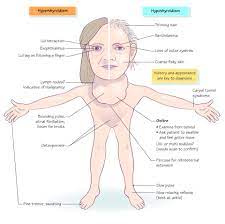 Hyper Vs Hypothyroidism Nursing School Endocrine Hypothyroidism Nursing Icu Nursing Nurse