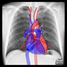 Anatomy is to physiology as geography is to history: Cardiomediastinal Anatomy On Chest Radiography Annotated Images Radiology Case Radiopaedia Org