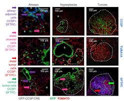 From wikipedia, the free encyclopedia. Club Cells Form Lung Adenocarcinomas And Maintain The Alveoli Of Adult Mice Elife