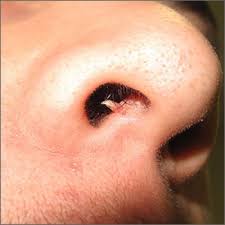 The septal cartilage or septum forms the wall between the two external nares 3, with usually, the two nostrils are of the same shape and size. Firm And Tender Growth In Right Nostril Mdedge Family Medicine