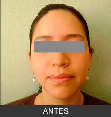 Este tratamiento estético solo equivale a un tiempo estimado de 45 minutos, siendo completamente favorable para quienes quieren resultados rápidos y completamente efectivos.se utiliza la anestesia local, haciendo que el dolor sea mínimo. Bichectomy Www Maxilofacialcdmx Mx