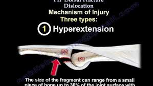 Image result for Interphalangeal Dislocation