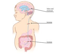 Spina Bifida Hydrocephalus And Spina Bifida Sydney Children S Hospitals Network