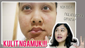 Kalau merasa perlu, gunakan juga pembersih muka yang berbahan dasar minyak atau lotion untuk menjaga kelembapan wajah setelah seharian. Cara Mengatasi Kulit Iritasi Merah Mengelupas Clogged Pores Kering Youtube