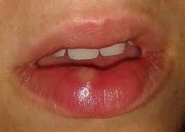 Aber wenn sie eines tages feststellen, dass muffin mehr aussieht als wenn sie schmollt, dann ist das wahrscheinlich ein medizinischer grund. Dicke Lippe D Gesundheit Herpes Lippenherpes