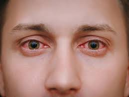 Image result for Gonococcal Conjunctivitis