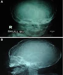 A significant difference between acute and chronic nch is the clinical presentation. Crouzon Syndrome An Experience Of Surgical Intervention At Bangabandhu Sheikh Mujib Medical University Bangladesh