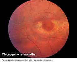 Choloquine Retinopathy A Long Term Complication Bulls Eye Macula Risk Age 60 Use For 5 Yr Dose 3mg Kg Retinal Photography Eye Health Optician Training