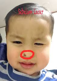 Beberapa artis yang sudah merasakan perawatan laser di klinik kami al. Laser Tanda Lahir 2 Kiyomimama Has Stories
