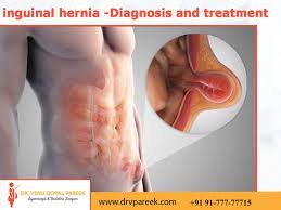 Inguinal Hernia -Diagnosis And Treatment