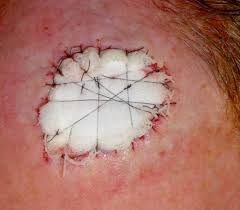 Post Op Wound Healing Care Dr Stretch