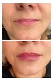 Miało być delikatnie 👄💉 Rewitalizacja i wypełnienie ust #rewitalizacjaust  #ustanapłasko #usta #wypełnienieust #kobieta #dziewczyna #swiecie #chelmno