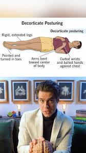 Image result for Decorticate Posturing