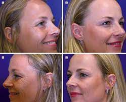 Posee además algunos efectos secundarios como reacciones alérgicas, rigidez facial, náuseas, y entre los efectos realmente no se si todo esto es consecuencia del botox. El Lado Oscuro Del Botox Del Entrecejo Al Engano