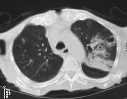 Legionella pneumophila is a gram negative, strictly aerobic bacterium of the. References In Cavitary Legionella Pneumonia In A Patient With Immunodeficiency Due To Hyper Ige Syndrome Journal Of Infection