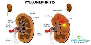 Pyelonephritis/Kidney Infection: Causes, Symptoms And Treatment