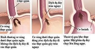 Trào ngược dạ dày thực quản là một hiện tượng sinh lý bình thường được hầu hết mọi người trải qua, đặc biệt là sau bữa ăn. Trao NgÆ°á»£c Dáº¡ Day Thá»±c Quáº£n Nhá»¯ng Ä'iá»u Cáº§n Biáº¿t Tuá»•i Tráº» Online
