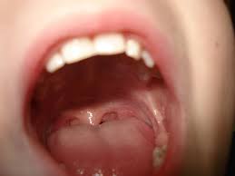 Image result for Erythroplakia roof of mouth