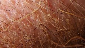 Like most hair on your body, pubic hair is thought to have some protective benefits. Trichomycosis Causes Symptoms And Treatment
