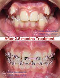 Braces Behel Jakarta Tangerang