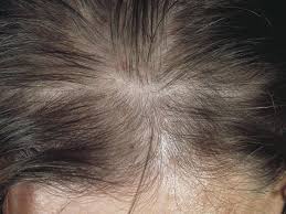 Dianette (diane 35) is a pill for birth control that contains something that suppresses the androgens in your body. Alopecia Androgenetica In Women Altmeyers Encyclopedia Department Dermatology